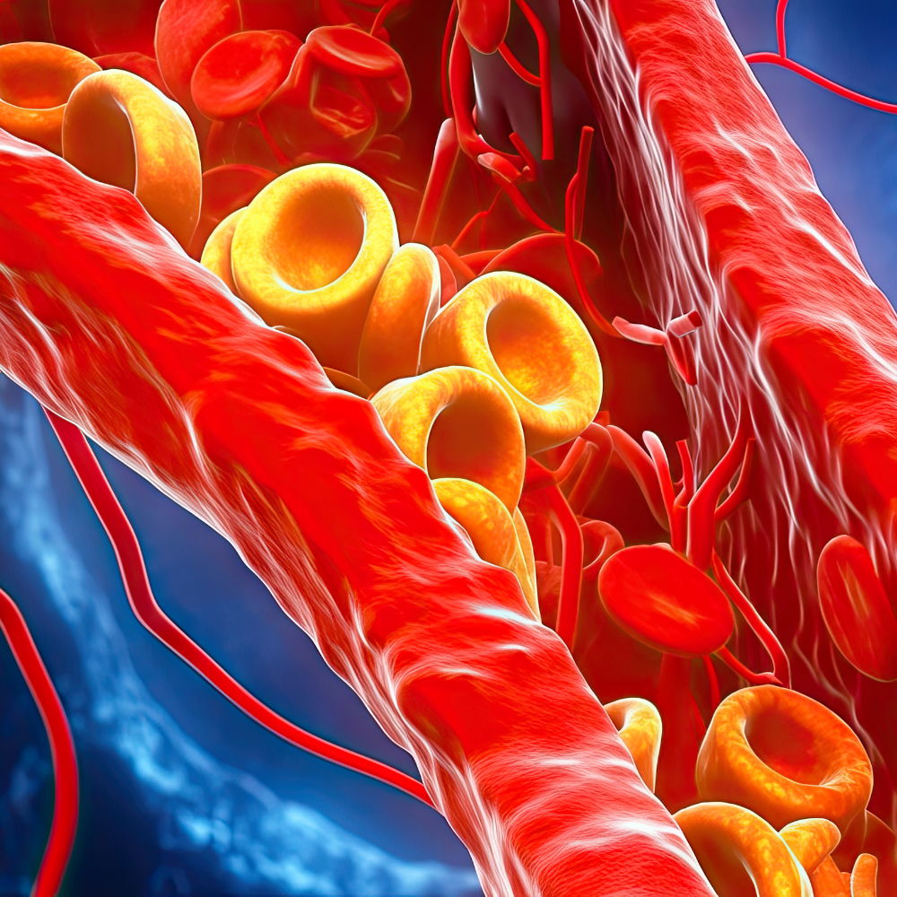 Hypercholesterolemia (Dyslipidemia) | High Cholesterol | Fats in Blood